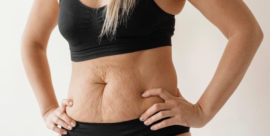 4 learn about the mommy makeover recovery process