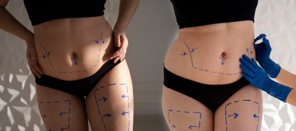 Liposuction vs. Liposculpture: Which Option is Best For Your Body?