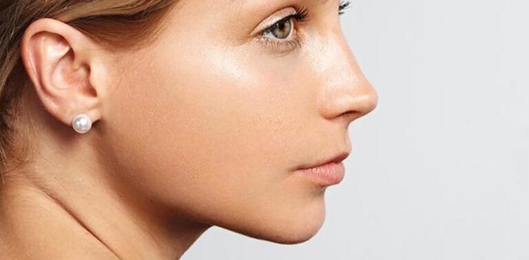 RhinoplastyA