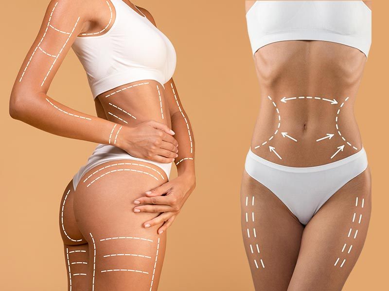 Best Lipo 360 in South Florida