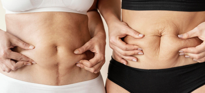 Lipo 360 vs Mommy Makeover