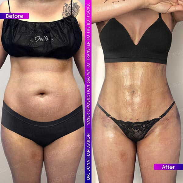 LipoVaser05 Jonathan