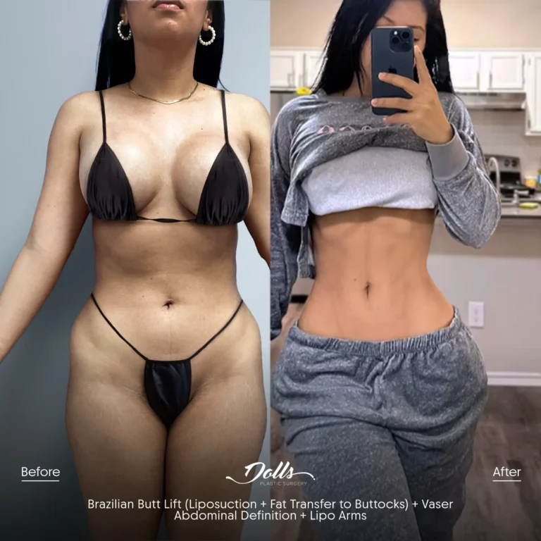BBL Ab Def Lipo Cell Saver Berman 1