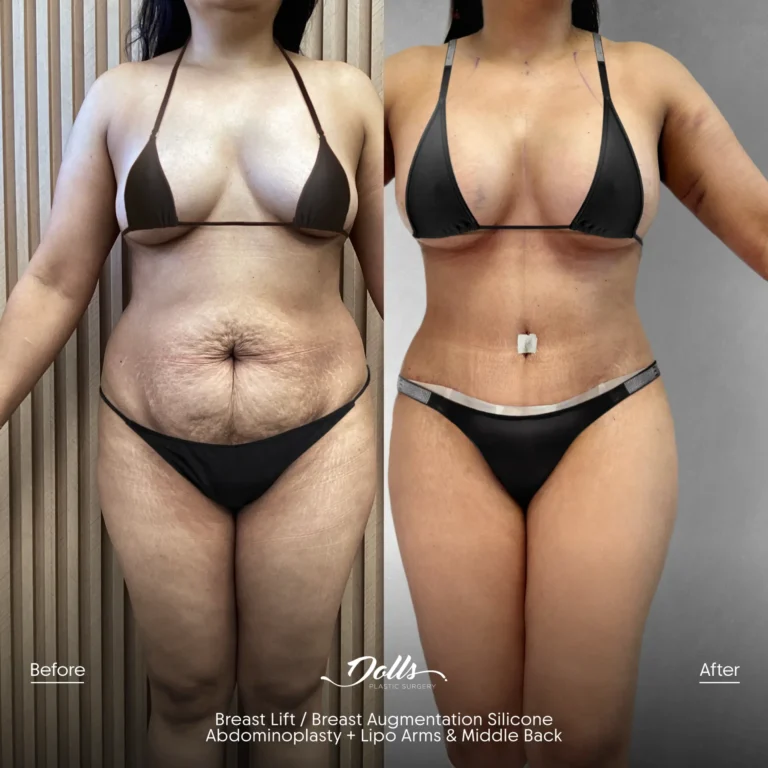 BL BAM TT Lipo Arms Zeichner Post