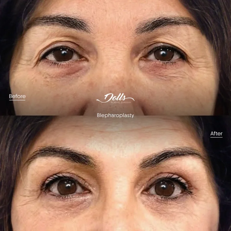 Blepharoplasty 1 1