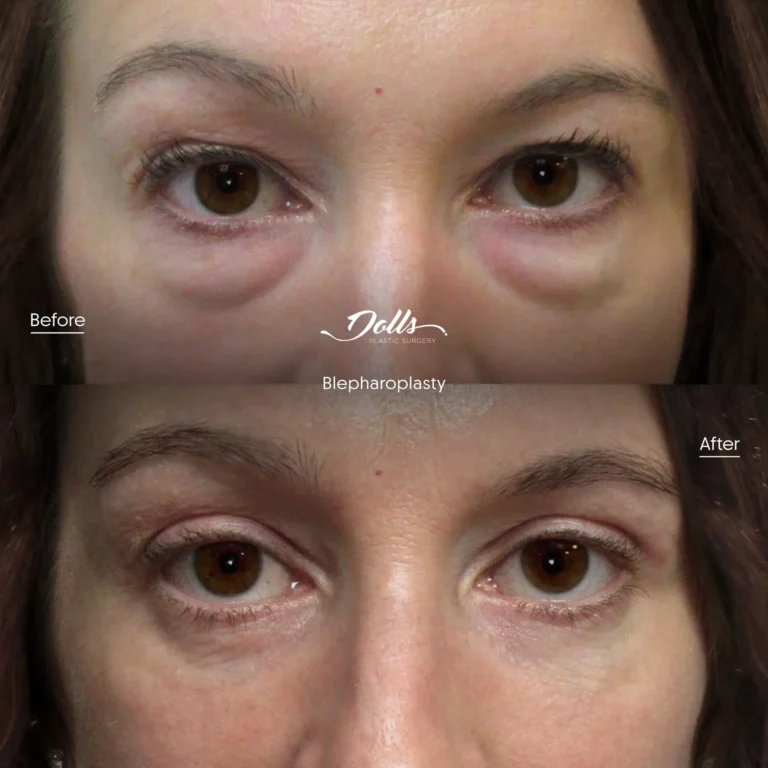 Blepharoplasty 10