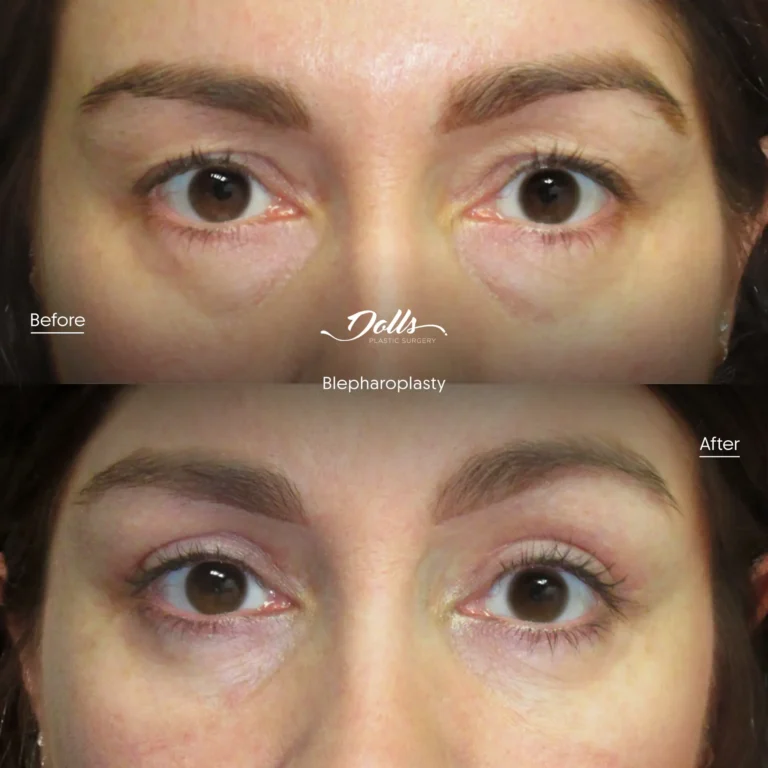 Blepharoplasty 14