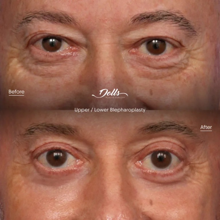 Blepharoplasty 7