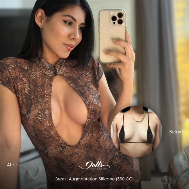 Breast Augmentation Silicone Berman