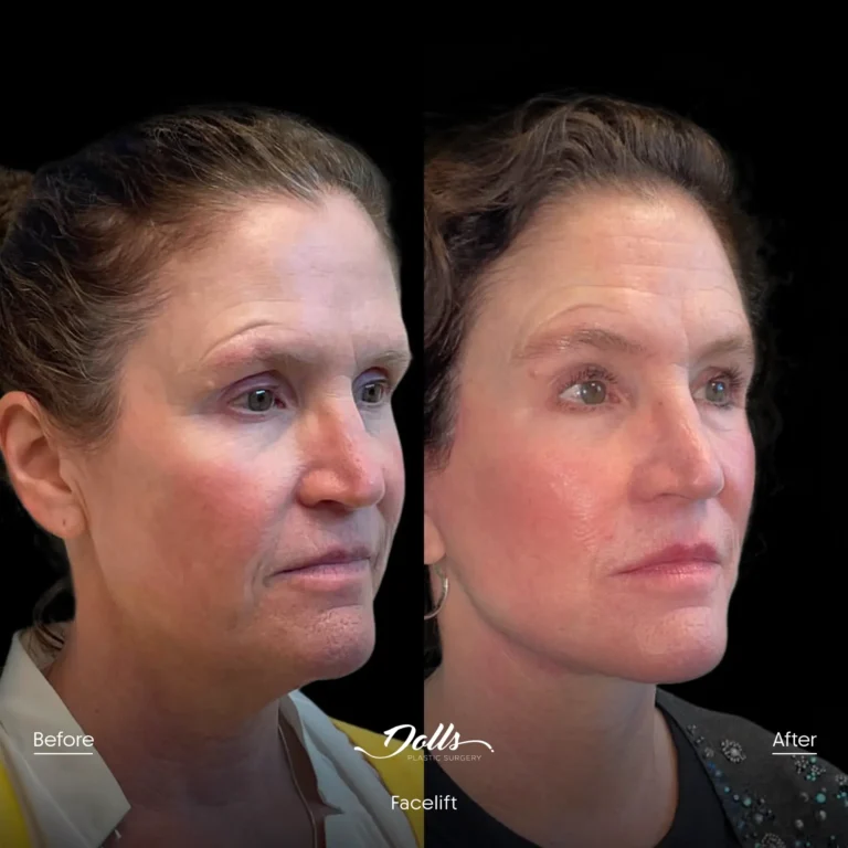 Facelift Gorodisky 4