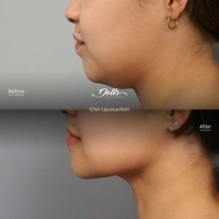 Lipo Chin 10