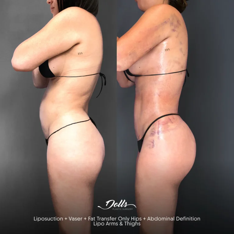 Lipo--Vaser-Fat-Transfer-Abd-Def-Jonathan