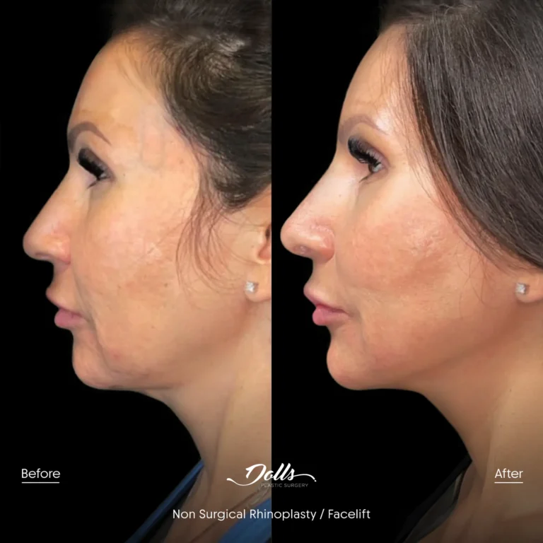 Non Surgical Facelift Rhinoplasty Gorodisky