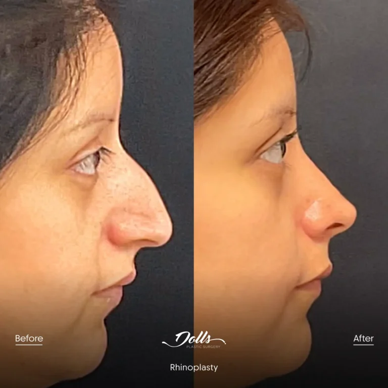 Rhinoplasty Dr Espinoza Post 4