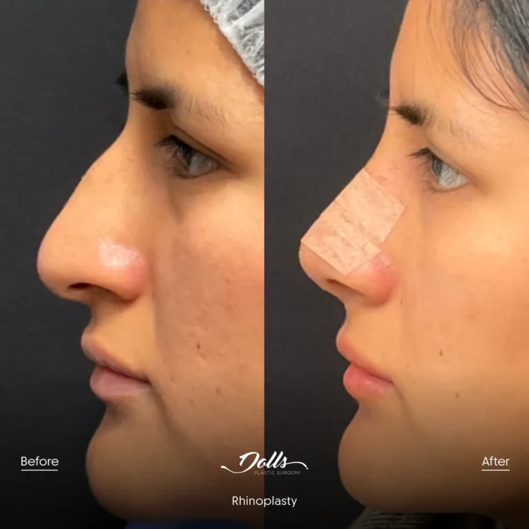 Rhinoplasty Dr Espinoza Post 5