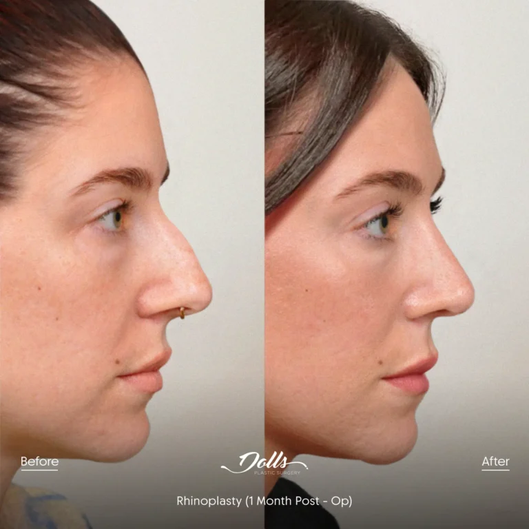 Rhinoplasty Espinoza