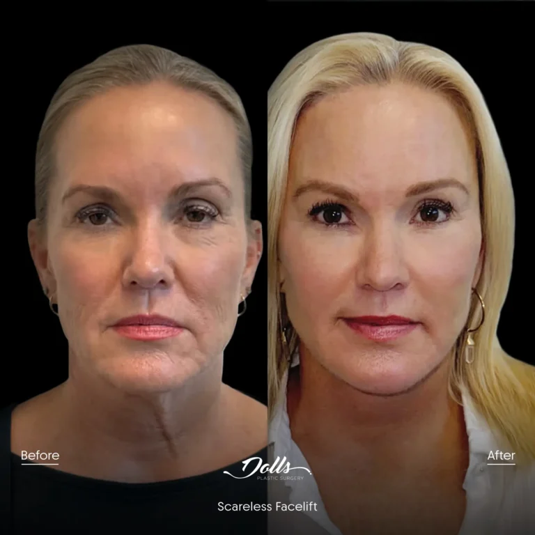 Scareless Facelift Gorodisky 2