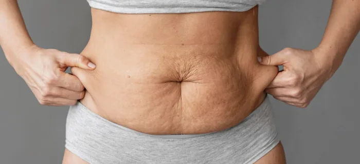 13 Tummy Tuck FAQ Patient Should Know