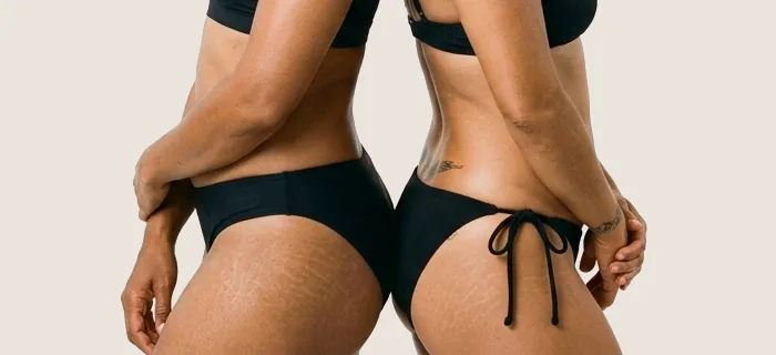 Eliminate Excess Skin and Fat with Tummy Tuck Surgery.