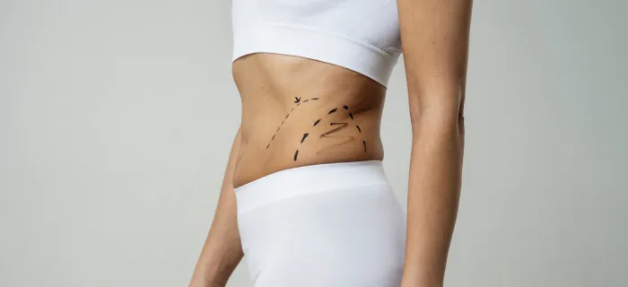 Liposuction,  the ultimate guide
