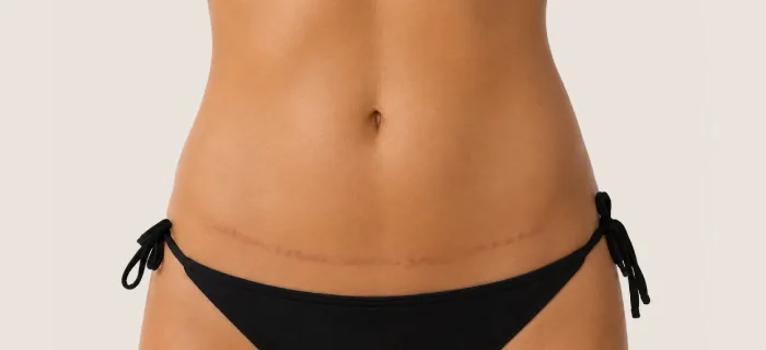 Safe and Effective Tummy Tuck Surgery