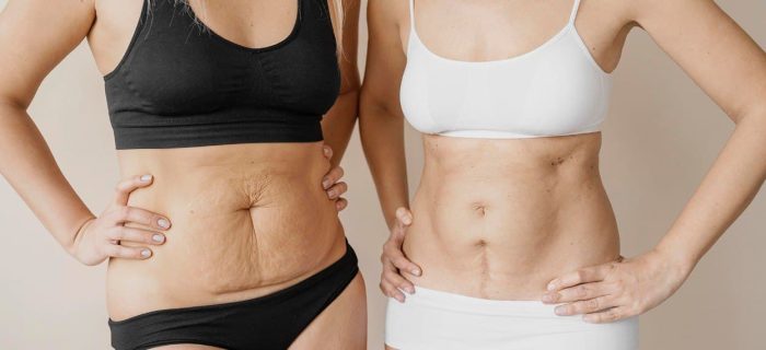 8 what does tummy tuck cosmetic surgery consist of