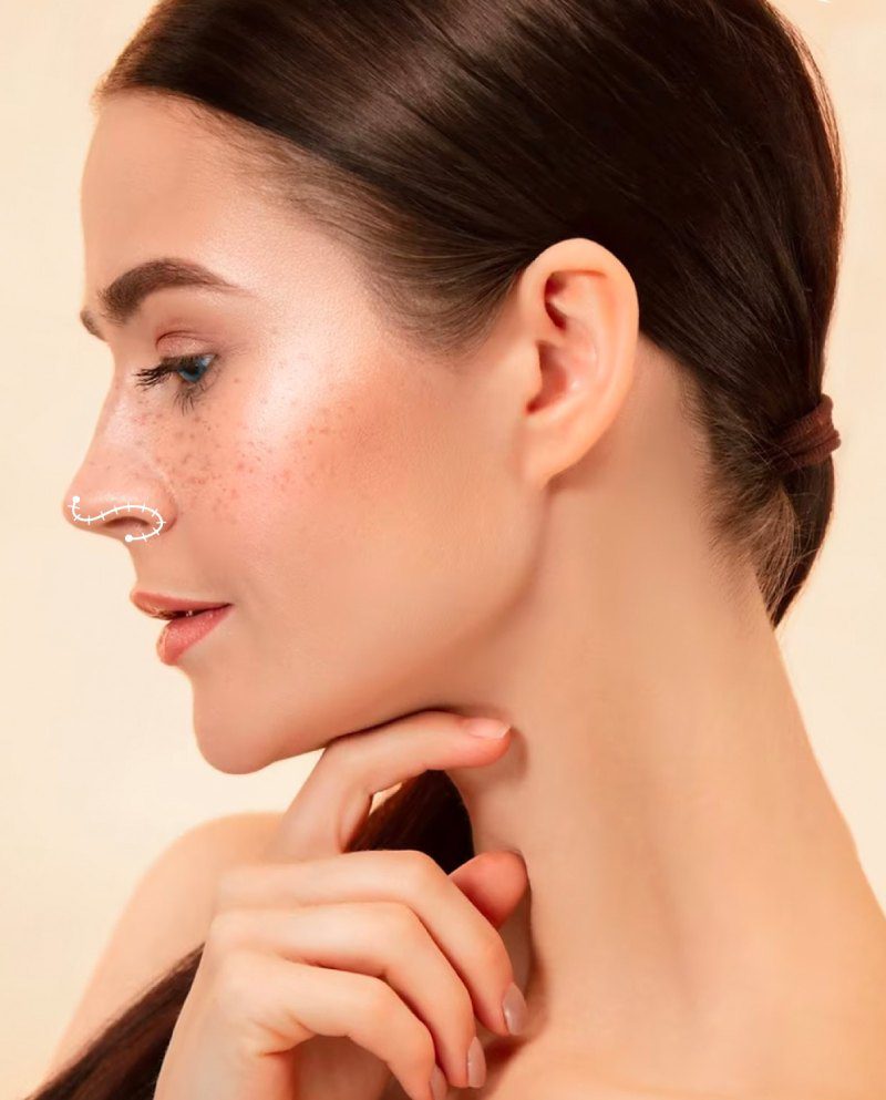 Rhinoplasty nose job miami