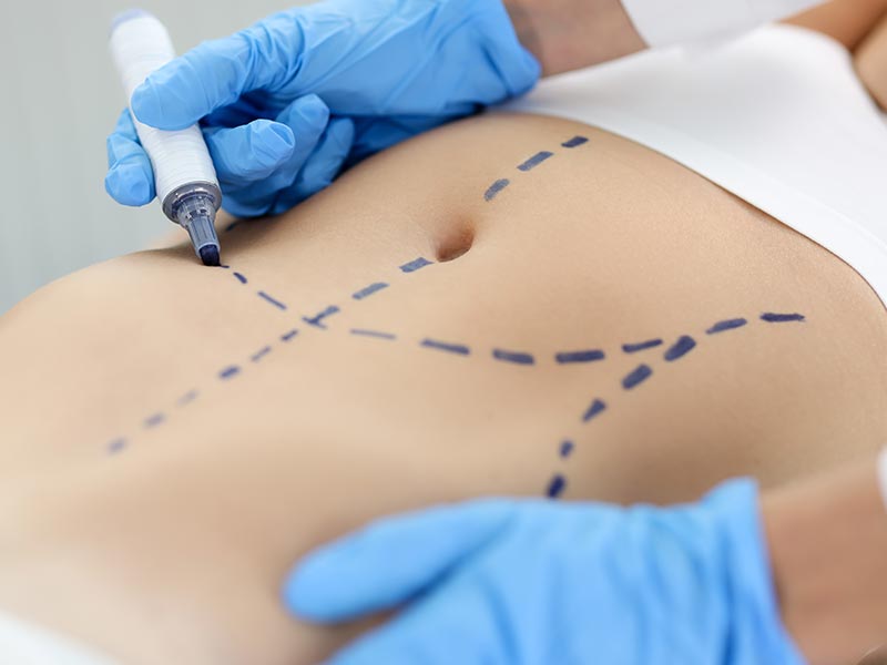 best tummy tuck surgeon in Miami FL