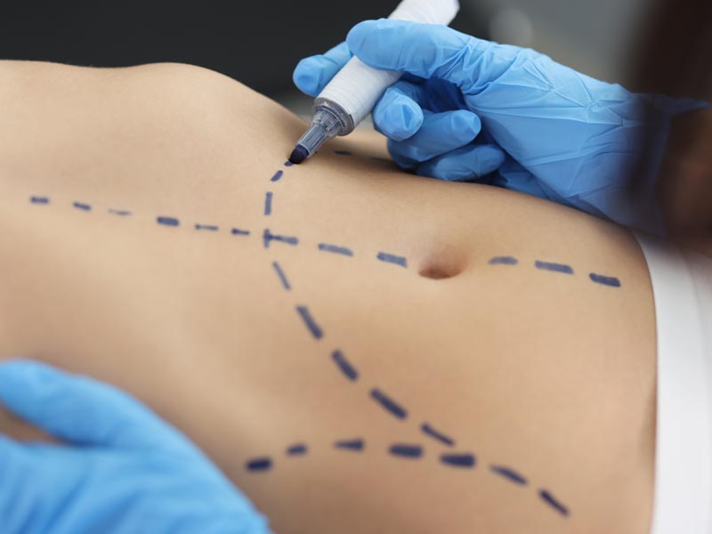 best tummy tuck surgeon in Miami FL